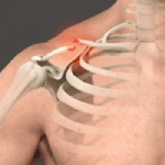 Clavicle Fracture