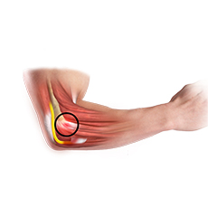 Common Extensor Tendon Origin Repair