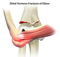 Distal Humerus Fractures of the Elbow