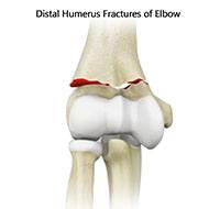 ORIF of the Distal Humerus Fractures