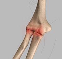 Elbow Arthritis