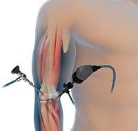 Elbow Arthroscopy