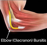 Elbow (Olecranon) Bursitis