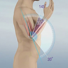 Elbow Contracture