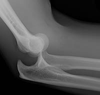 Elbow Dislocation