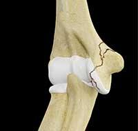 Elbow Fractures