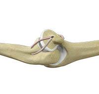 Elbow Ligament Reconstruction