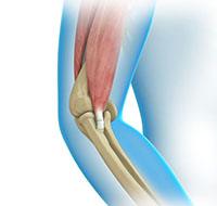 Elbow Tendon and Ligament Repair