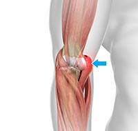 Golfer's Elbow