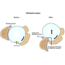 Hill-Sachs Lesion