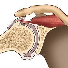 Internal Impingement of the Shoulder