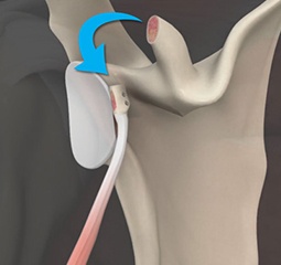 Latarjet Procedure