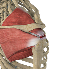 Massive Retracted Rotator Cuff Tear