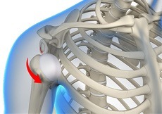 Multidirectional Instability of the Shoulder