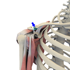 Mumford Distal Clavicle Excision