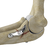 ORIF of the Coronoid Fractures