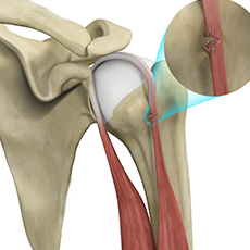 Proximal Biceps Tendon Rupture