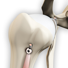 Proximal Biceps Tenodesis