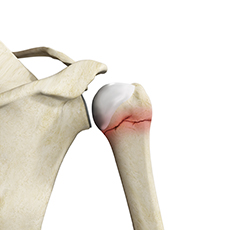 Proximal Humerus Fractures