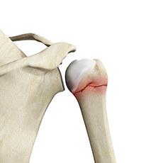 Proximal Humerus Fractures