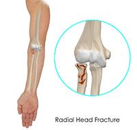 Radial Head Fractures of the Elbow