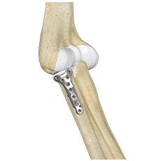 Radial Head ORIF and Replacement