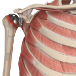 Revision Shoulder Replacement