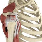 Rotator Cuff Tear