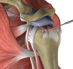 Rotator Cuff Pain