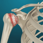 Arthritis of the Shoulder