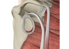 Shoulder Labral Tear