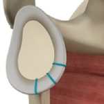 Shoulder Labrum Reconstruction