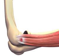 Tennis Elbow Surgery