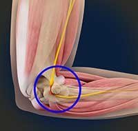 Cubital Tunnel Syndrome (Ulnar Nerve Entrapment)